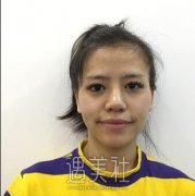 曹卫刚脂肪填充修复怎么样|自体脂肪填充面部案例分享~ width=