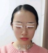 王世勇修复双眼皮怎么样：真实案例看的见~ width=