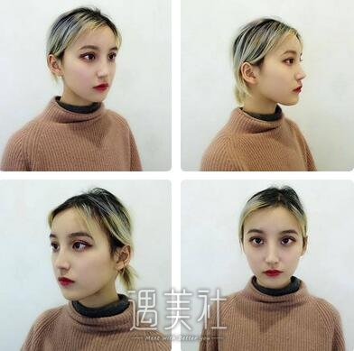 杨明勇,双眼皮修复