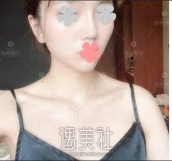林沸腾,隆胸