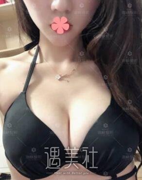 林沸腾,隆胸
