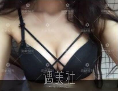 林沸腾,隆胸