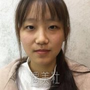 华西医院割双眼皮案例：曾经的我在在线卑微~ width=