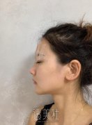 南方医院整形科冯传波怎么样?看看我割双眼皮的案例有多自然。 width=
