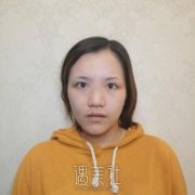 华西医院割双眼皮案例：术后100天恢复记录+真实照片 width=