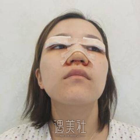 华西医院,割双眼皮