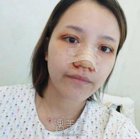 华西医院,割双眼皮