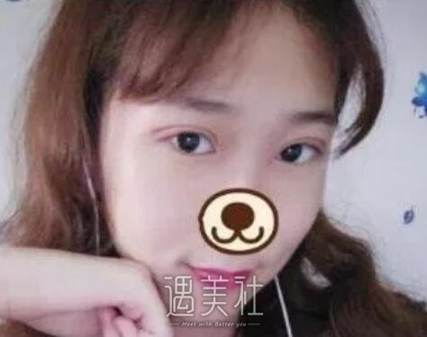 南京,军区总院美容科,割双眼皮