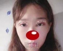 南京军区总院美容科割双眼皮好吗？有没有案例？ width=