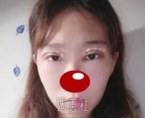 南京,军区总院美容科,割双眼皮