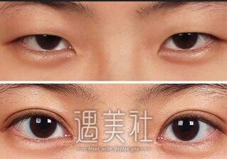 上海,九院,眼部手术