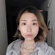 华西卿勇双眼皮有多赞|内附四川华西医院美容科价格表~ width=