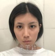 邱立东填充到底怎么样?自体脂肪面部填充案例惨不忍睹~ width=