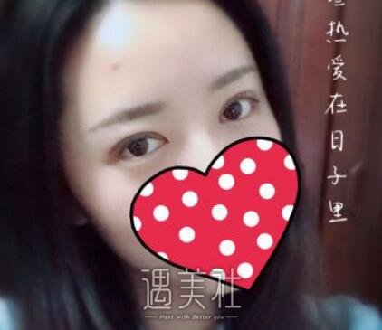 吉大一院整形,科割双眼皮