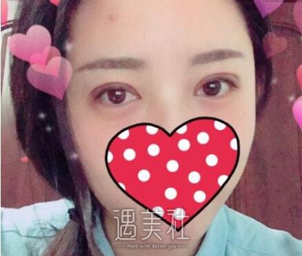 吉大一院整形,科割双眼皮