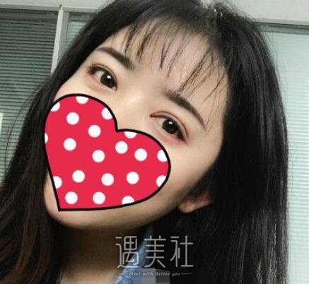 吉大一院整形,科割双眼皮