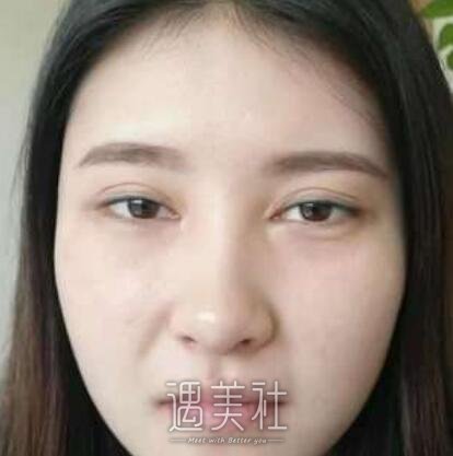 华西医院美容科,肖海涛,双眼皮修复