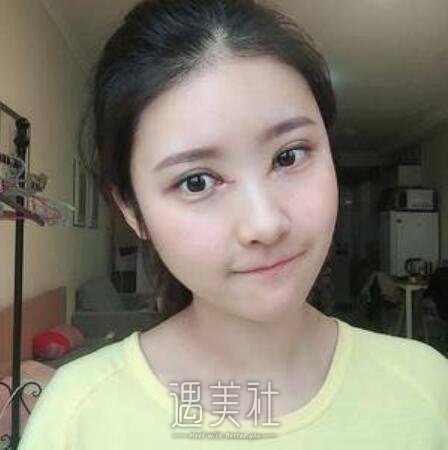 华西医院美容科,肖海涛,双眼皮修复