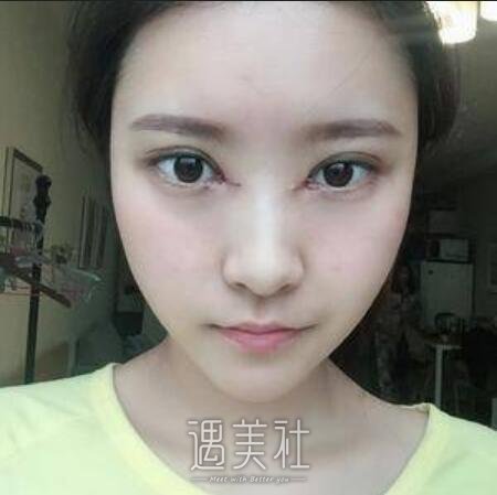 华西医院美容科,肖海涛,双眼皮修复