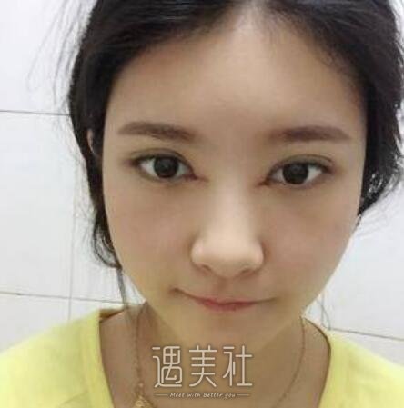 华西医院美容科,肖海涛,双眼皮修复