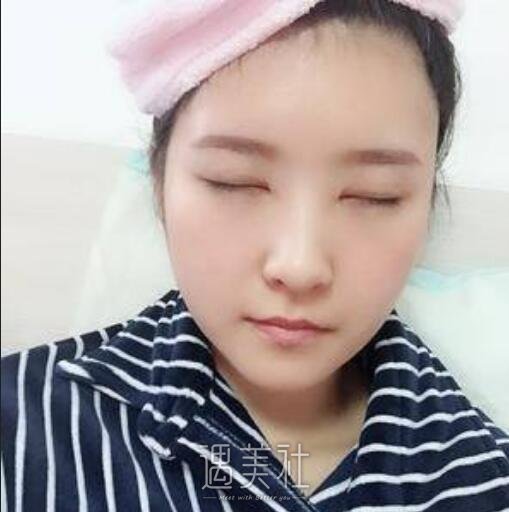 华西医院美容科,肖海涛,双眼皮修复