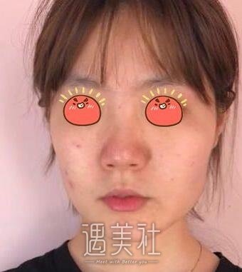上海,九院,韦敏,磨骨