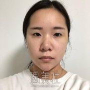 韩旭双眼皮失败案例多不多，快来看看我的失败没有~ width=