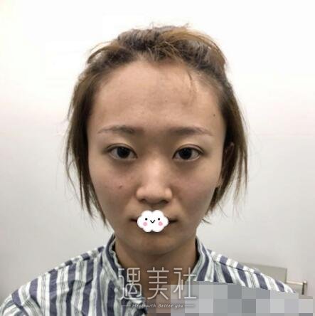 戴传昌，隆鼻