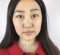 脸部吸脂术优劣势一览 width=
