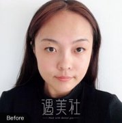 连云港大明整形双眼皮案例恢复前后对比图~ width=