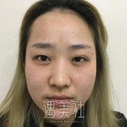 贾明医生割双眼皮怎么样?恢复前后对比图分享~ width=