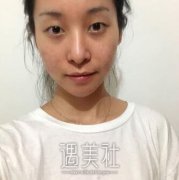 兰州梦想整形双眼皮恢复过程分享：还有对比图哦~ width=