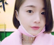中山三院颜玲双眼皮：花了我一万多看看值得不~ width=