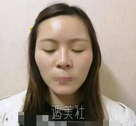 芳艺整形双眼皮
