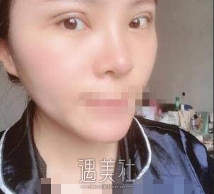 芳艺整形双眼皮