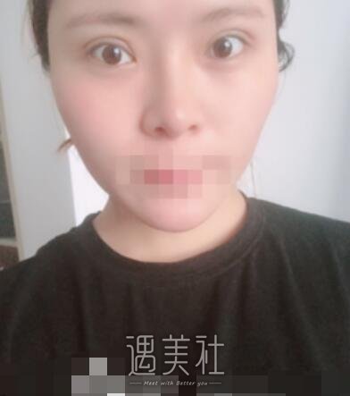 芳艺整形双眼皮