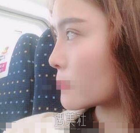 芳艺整形双眼皮