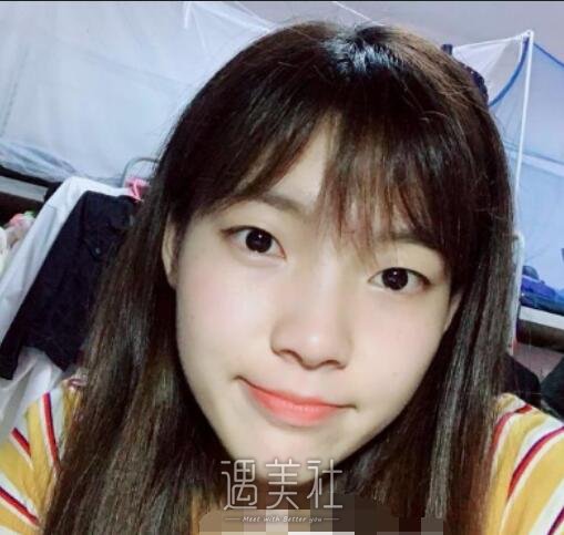 华美,全切双眼皮