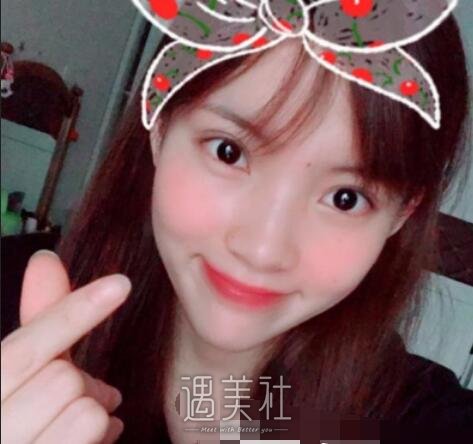 华美,全切双眼皮
