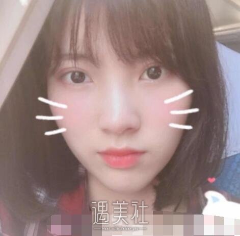 华美,全切双眼皮