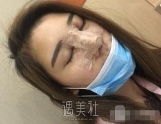 李战强隆鼻案例：三个月了我的是不是失败了~ width=
