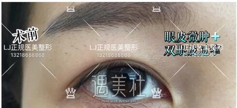 lj医美双眼皮