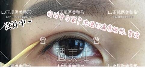 lj医美双眼皮
