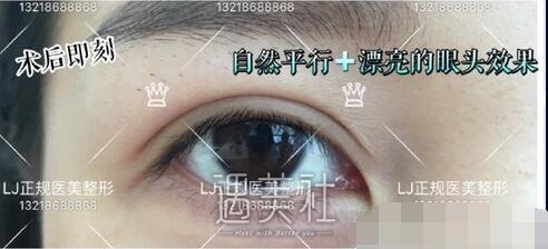 lj医美双眼皮