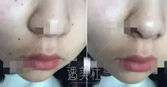 苏大附一院,激光点痣