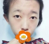 薛志强整容技术好么?双眼皮案例 width=