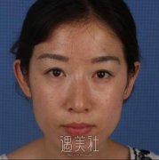 河南整形美容医院磨骨真人案例曝光  width=