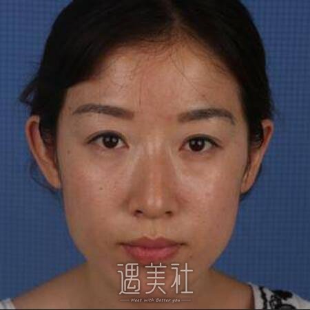 河南整形美容医院,磨骨