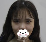尤建军做鼻子怎么样？真实案例半年恢复全记录 width=