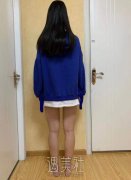 曹卫刚吸脂案例：大腿吸脂恢复是不是失败呢? width=